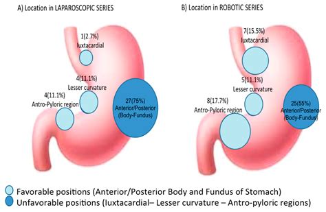 Cancers | Free Full-Text | Minimally Invasive Approach to Gastric GISTs ...