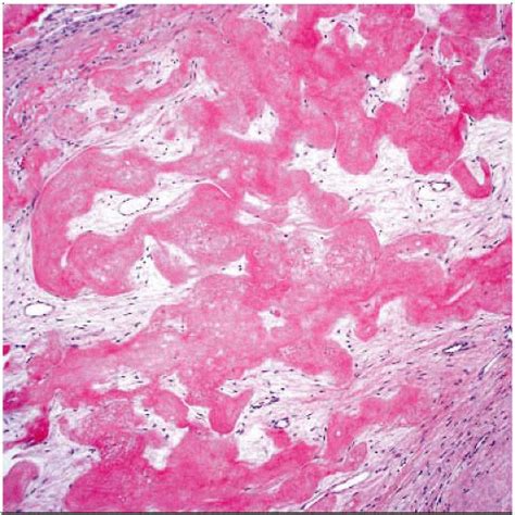 Multiloculated Bone Cyst Histology