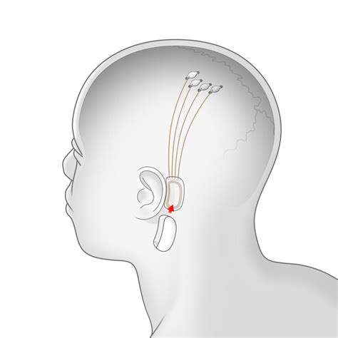 elon musk's neuralink brain implant lets you control tech with your mind