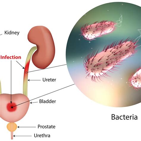 (PDF) UroPathogenic Escherichia coli (UPEC) Infections: Virulence ...