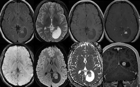 Pilocytic Astrocytoma