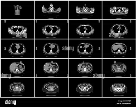 Ct scan abdomen hi-res stock photography and images - Alamy