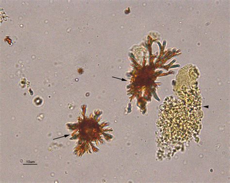 Bilirubin Crystal In Urine