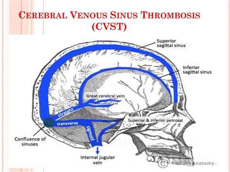 PPT - Cerebral Venous Sinus Thrombosis (CVST) PowerPoint Presentation, free download - ID:7603213