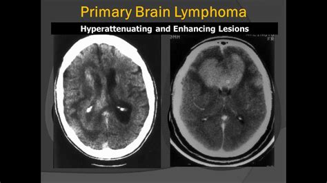 Corpus Callosum Primary CNS Lymphoma (PCNSL): Radiologic-Pathologic Correlation - YouTube