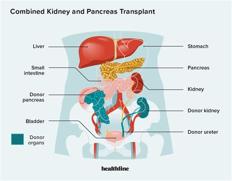 Kidney Pancreatic Transplant: Procedure, Recovery, Outlook, and More