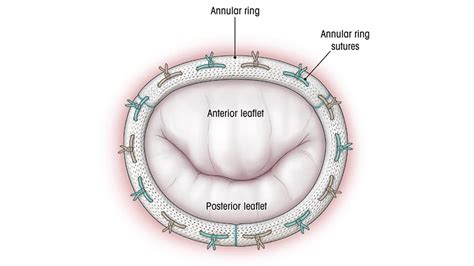 Minimally Invasive Mitral Valve Repair