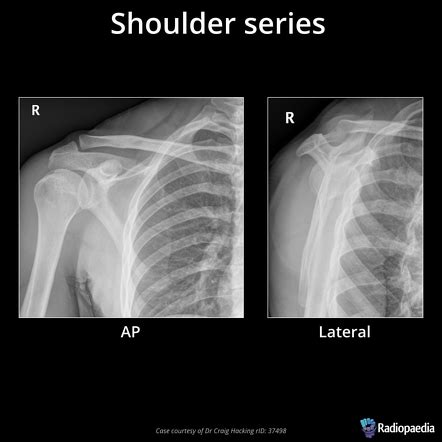 Shoulder Joint X Ray