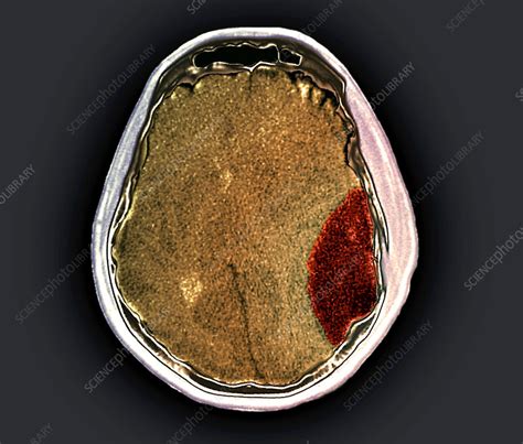 Skull fracture, CT scan - Stock Image - C055/2657 - Science Photo Library