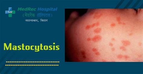 Mastocytosis Causes, Symptoms, Prevention & Treatment