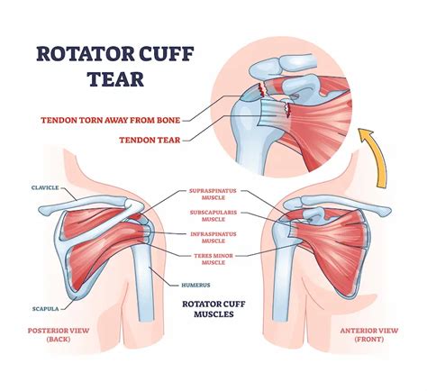 Asquith Health - Rotator Cuff Tears