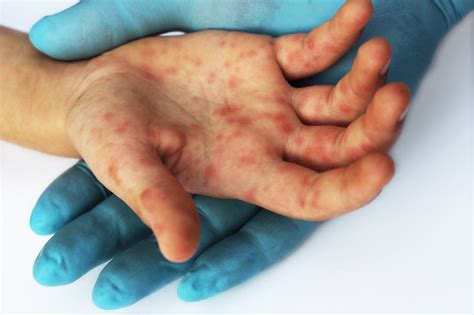 Enterovirus A71 Vaccine Effective in Preventing Non-Severe Hand, Foot ...