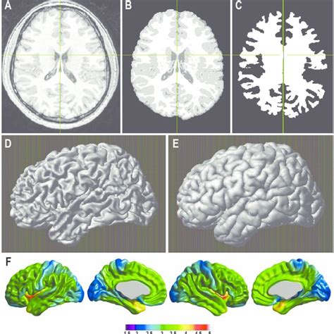 An outline of the cortical thickness measurement pipeline. (A) data are ...