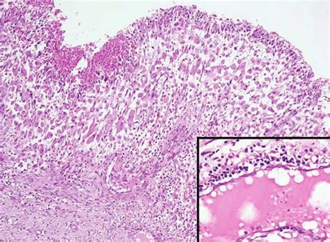 Section showing hyperplastic synovium and fibrinous exudate on surface... | Download Scientific ...