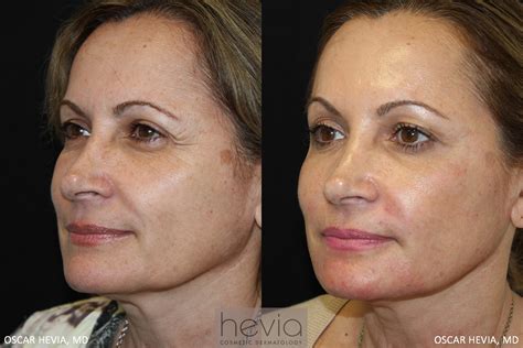 Liquid Facelift | Miami Cosmetic Dermatologist | Dr. Oscar Hevia