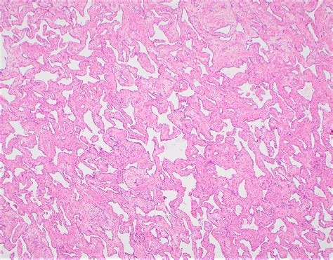 Pathology Outlines - Hemangioma