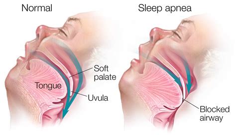 Sleep Apnea (Berdengkur): Penyebab & Gejala - Premier Clinic