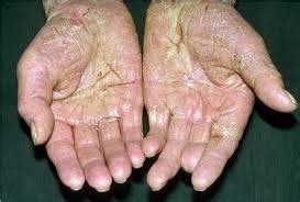 Skin Diseases