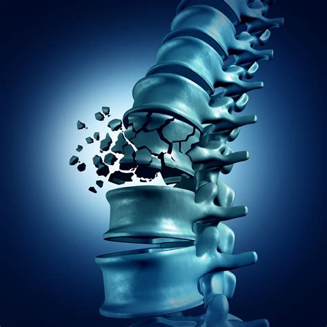 What Is a Spinal Fracture? | PainScale