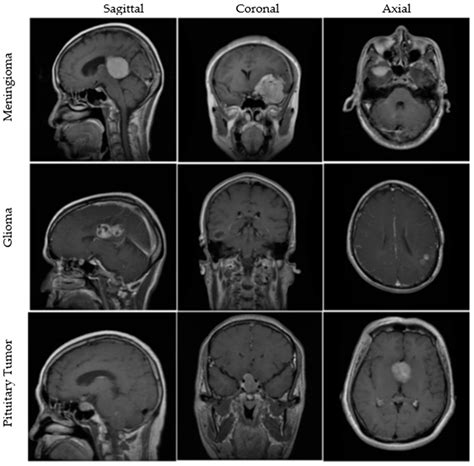 Brain Mri Tumor