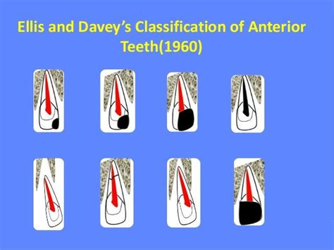 Restoration of traumatically fractured anterior teeth