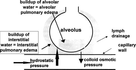 Condition Specific Radiology: Interstitial Pulmonary Edema - Stepwards