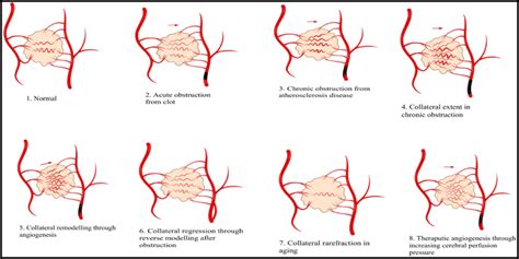 Lifecycle of cerebral collateral circulation | Download Scientific Diagram