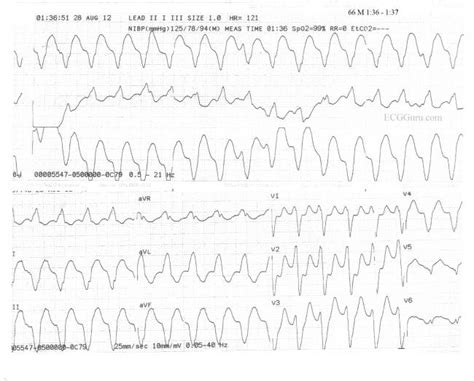 V Tach | ECG Guru - Instructor Resources