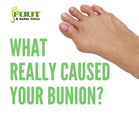 What Really Caused Your Bunion? - Foot and Ankle Clinic