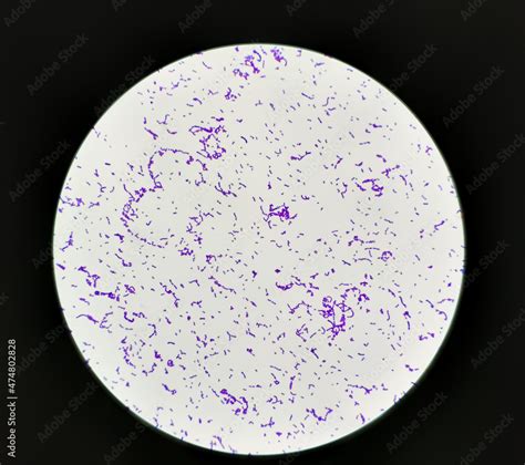 Streptococcus pyogenes infected in aged patient, showing of gram's ...