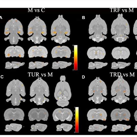 ALFF difference brain regions map. (A) Brain regions with decreased ...