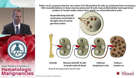 Debate: A Case of Stage IV Follicular Lymphoma - R-CHOP or B-R