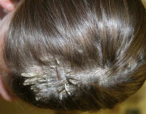 Psoriasis: scalp psoriasis