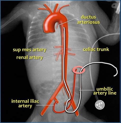 Umbilical Artery