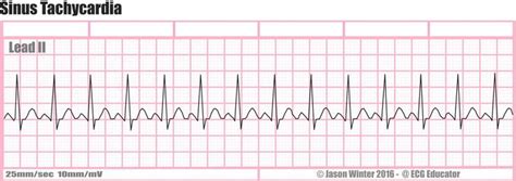 Pin by Jason Winter (ECG Educator). on Six second ECG strips | Atrial ...