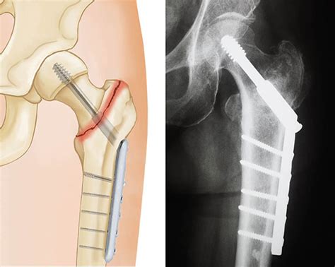 Hip Fracture - Dr. Mukhi’s Raj Hospital