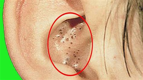 How do you get rid of blackheads in your ears? - YouTube