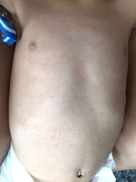 Roseola Rash