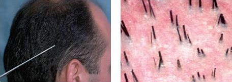 Miniaturization: Cause of Hair Loss | Bernstein Medical