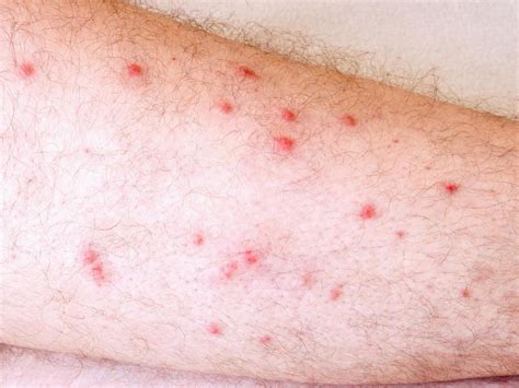 Mold Allergy Skin Rash