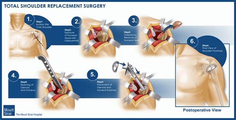 Orthopedic surgery, Orthopedics, Shoulder replacement surgery