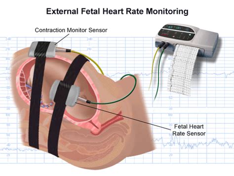 External and Internal Heart Rate Monitoring of the Fetus