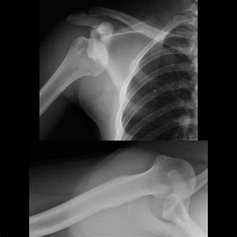 Teenager with shoulder pain after a football injury | Pediatric ...