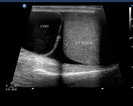 Espermatocele