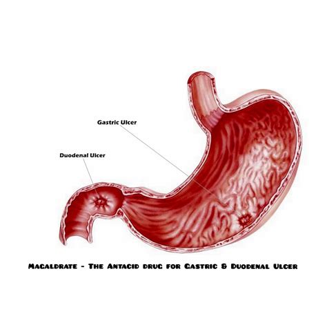 Magaldrate - The Antacid Drug For Gastric & Duodenal Ulcer | Anzen Exports