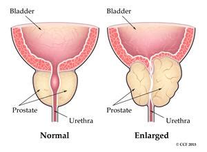 Benign Prostatic Hyperplasia (BPH): Symptoms & Treatments