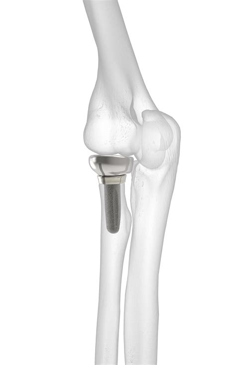 Anatomic Radial Head | Acumed