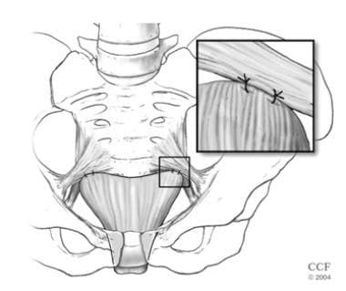 Sacrospinous Ligament Suspension