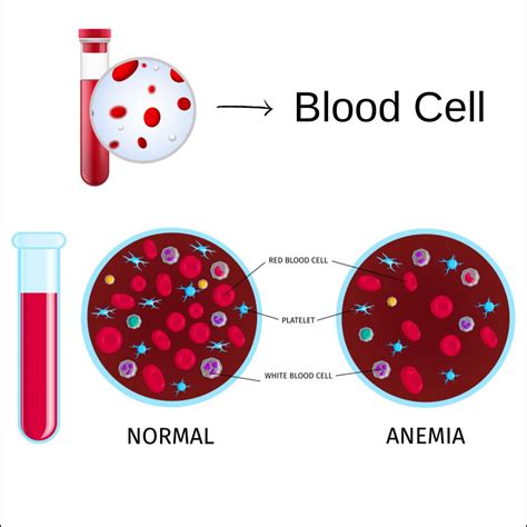 Iron Anemia in Women: Causes, Signs & Treatment