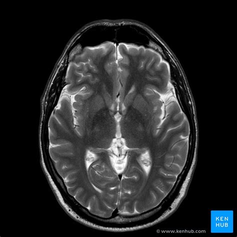 Brain MRI: How to read MRI brain scan | Kenhub